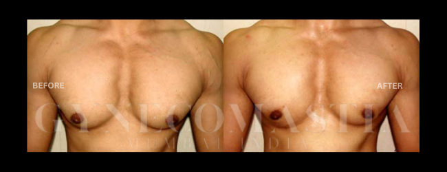 Gynecomastia Grade I