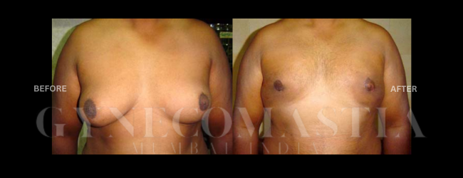 Gynecomastia Grade III