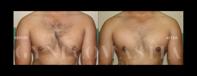 Gynecomastia Grade I