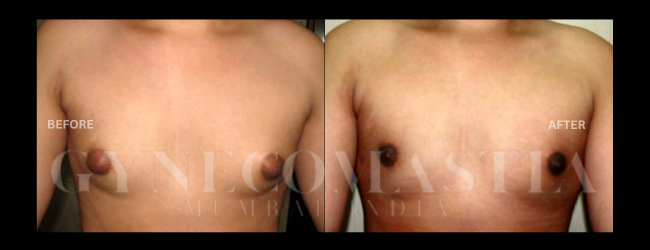 Gynecomastia Grade II