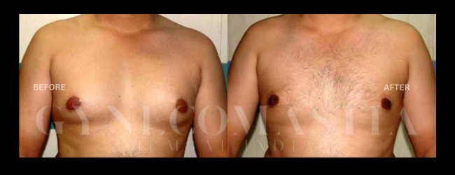 Gynecomastia Grade II