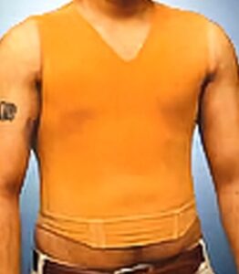 Gynecomastia Compression Garment