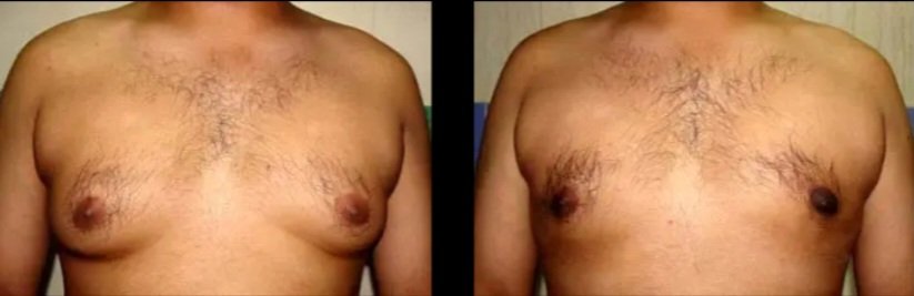 Bilatera Gynecomastia