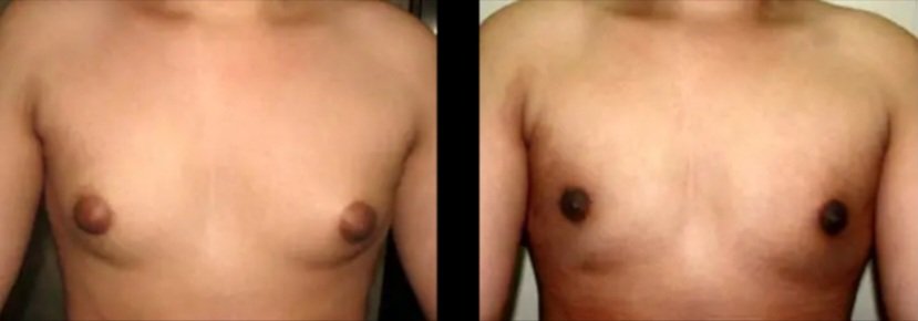 Gynecomastia Grade II-a