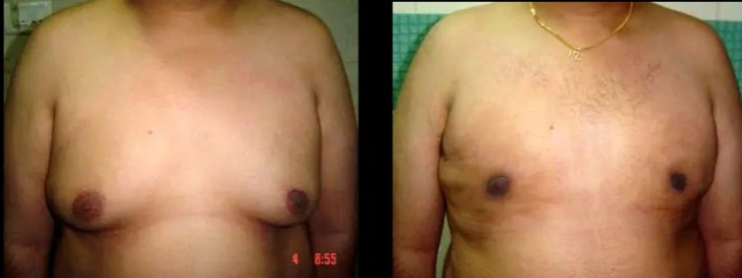 Gynecomastia Grade II-b