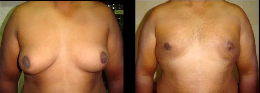 Gynecomastia Grade III