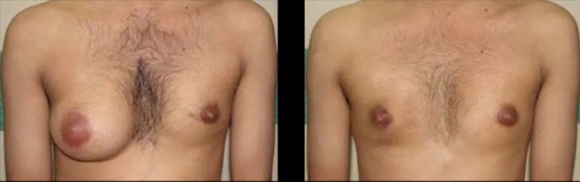 Unilateral Gynecomastia